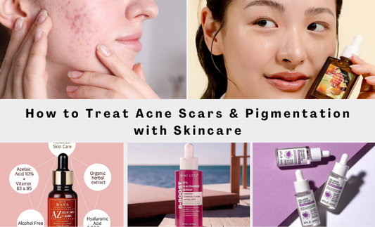 Understanding Acne Scars & Pigmentation